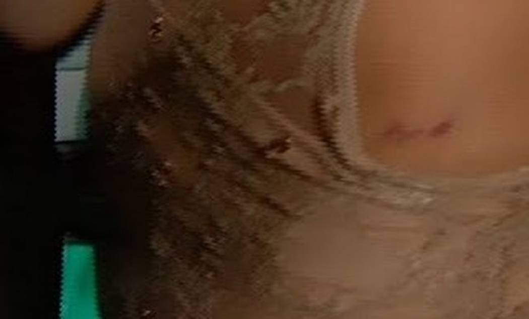 VIDEO: Η Αγγελική Ηλιάδη δείχνει το τραύμα της