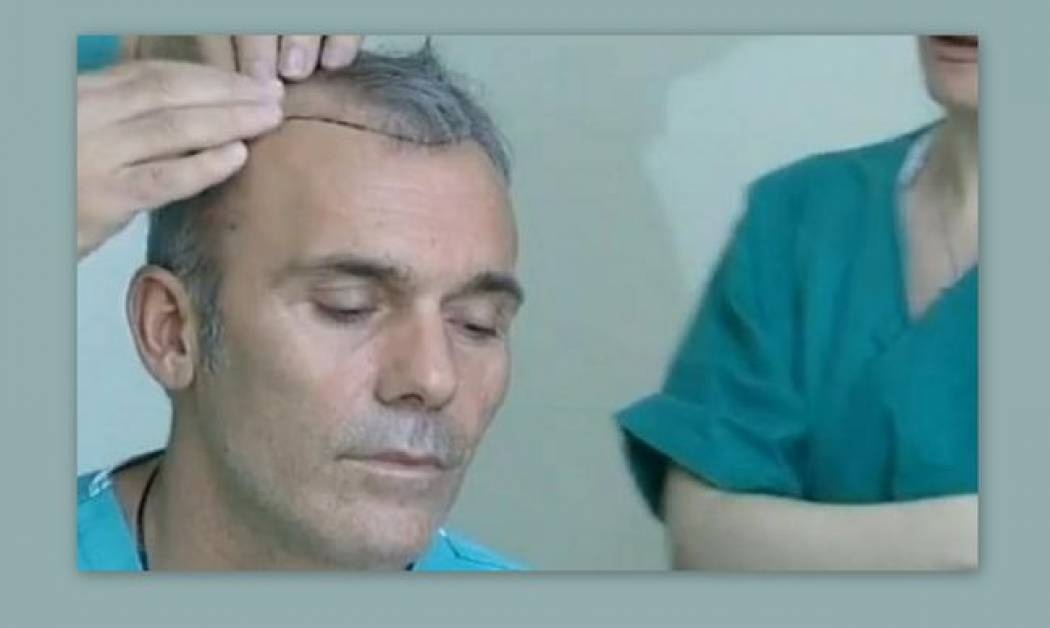 Video: Ο Ρόκκος κάνει μεταμόσχευση μαλλιών μπροστά στην κάμερα!
