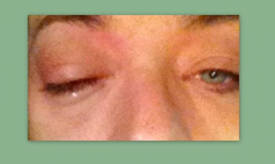 Με μαυρισμένο μάτι γνωστός τραγουδιστής μετά από επίθεση! (φωτό)