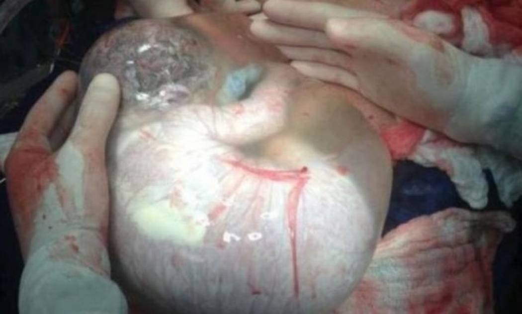 Η συγκλονιστική φωτογραφία μωρού μέσα στον αμνιακό σάκο που έφερε στον κόσμο Έλληνας γιατρός, κάνει τον γύρο του κόσμου!