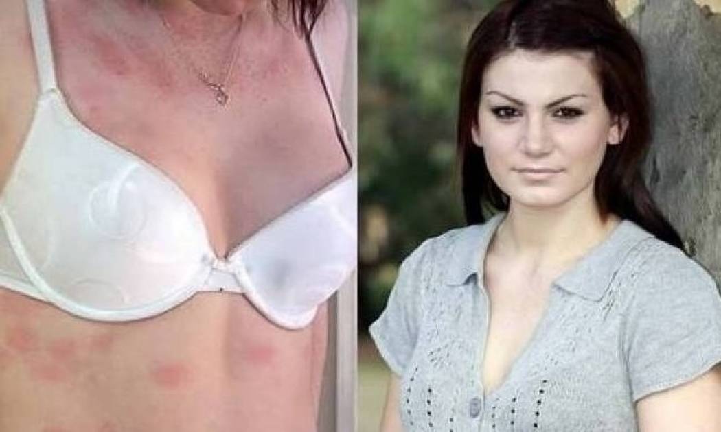 Το κορίτσι που είναι αλλεργικό στο νερό