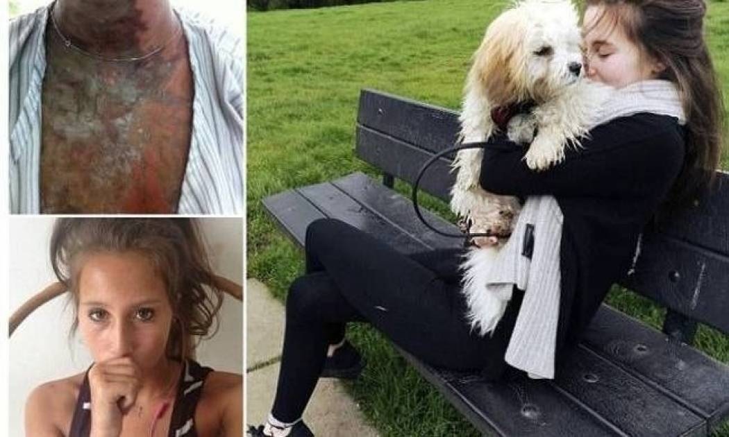 19χρονες δέχθηκαν απάνθρωπη επίθεση με οξύ (pics)