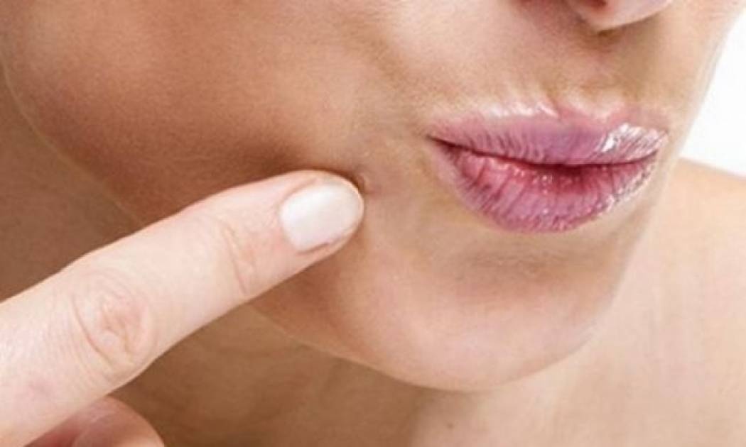 Μυρμηγκιές: Τι είναι, πώς μεταδίδονται, πώς αντιμετωπίζονται