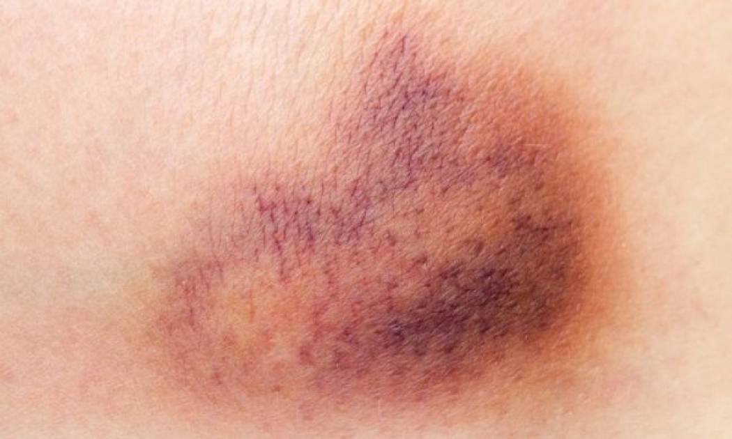 Μελανιάζετε με το παραμικρό; Δείτε τι φταίει