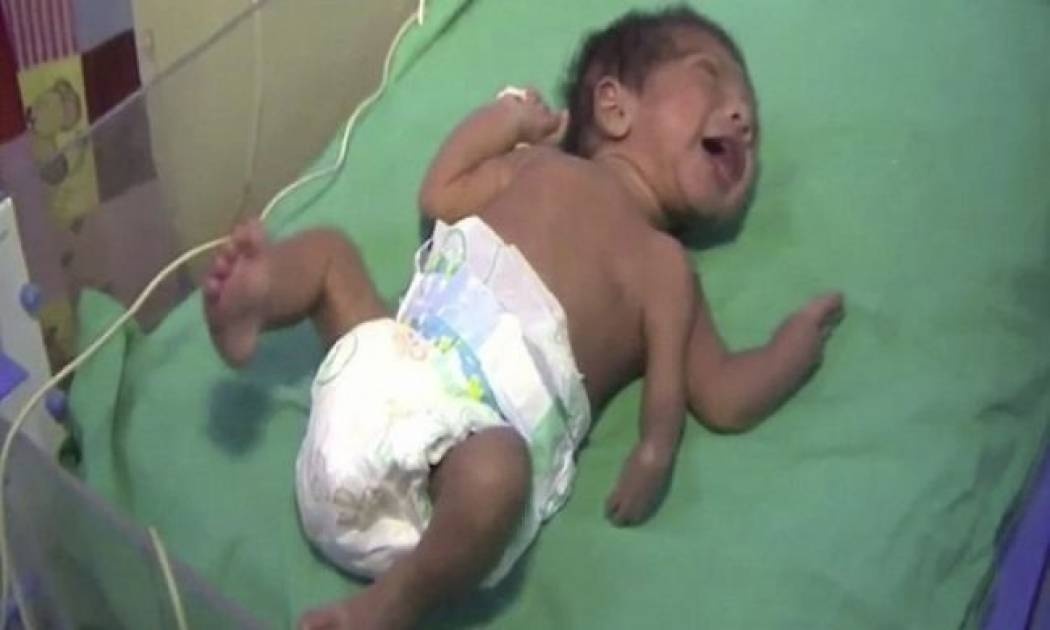 Μωρό με τρία χέρια υποβλήθηκε σε σωτήρια επέμβαση (βίντεο)