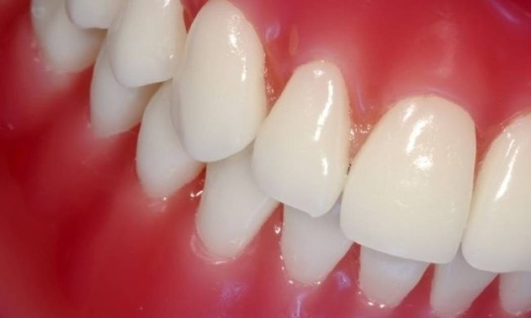 Ουλίτιδα: Γνωρίστε τα συμπτώματα για να την προλάβετε εγκαίρως