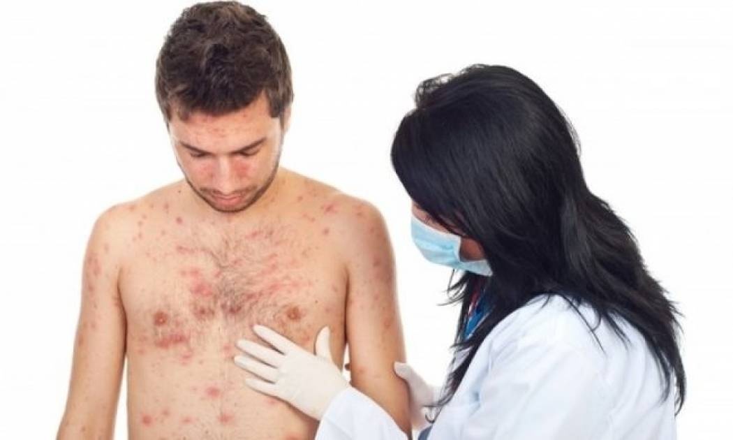 Ανεμοβλογιά στους ενήλικες: Γιατί είναι επικίνδυνη