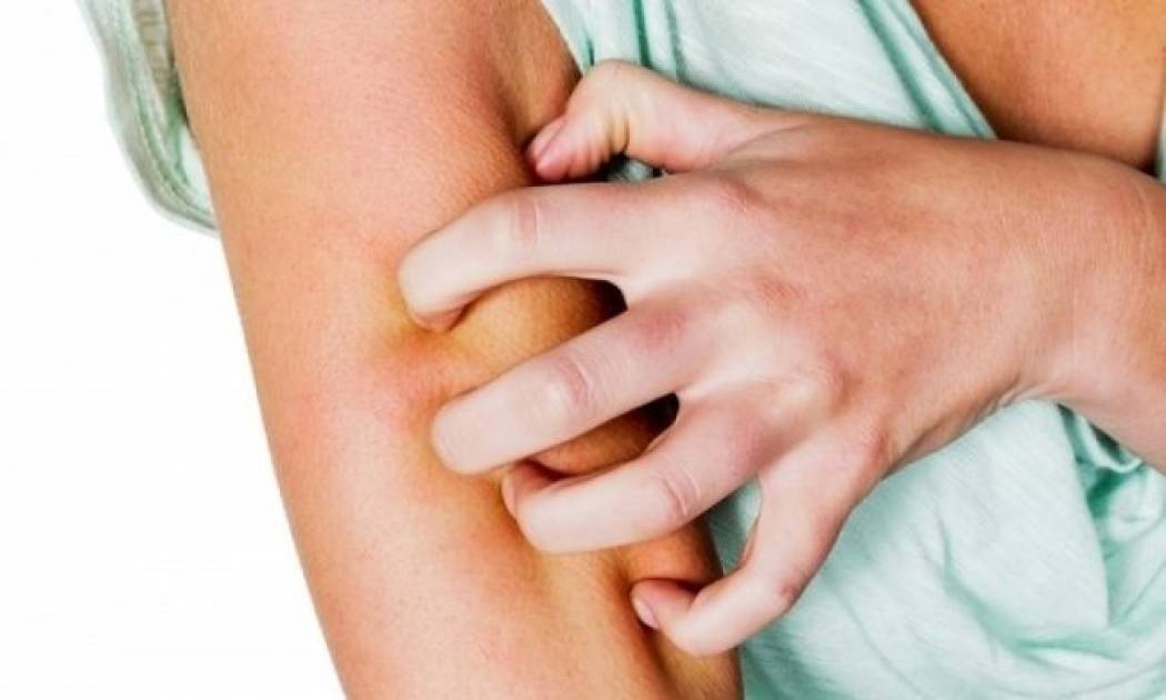 Νευροδερματίτιδα: Όσα πρέπει να ξέρετε για την ατοπική πάθηση