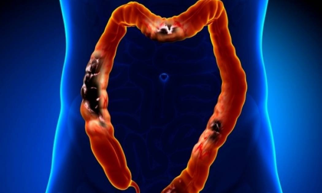 Καρκίνος παχέος εντέρου: Πώς να προφυλαχθείτε