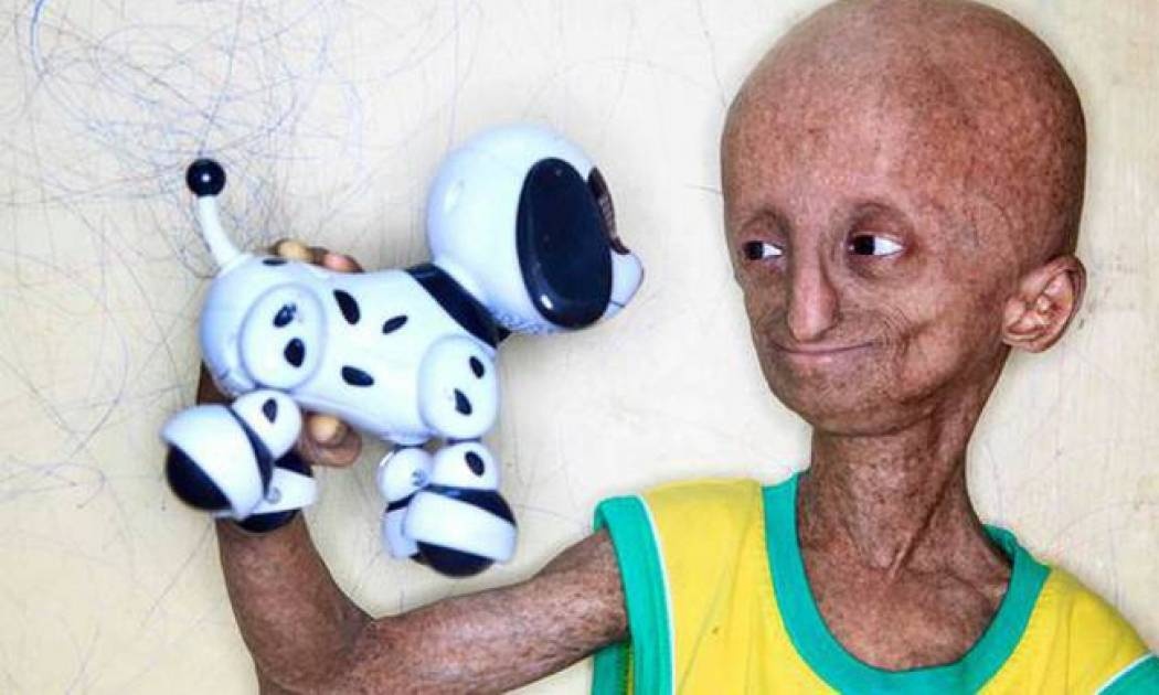 Το ηλικιωμένο… αγοράκι που γερνά οκτώ φορές γρηγορότερα (photos)