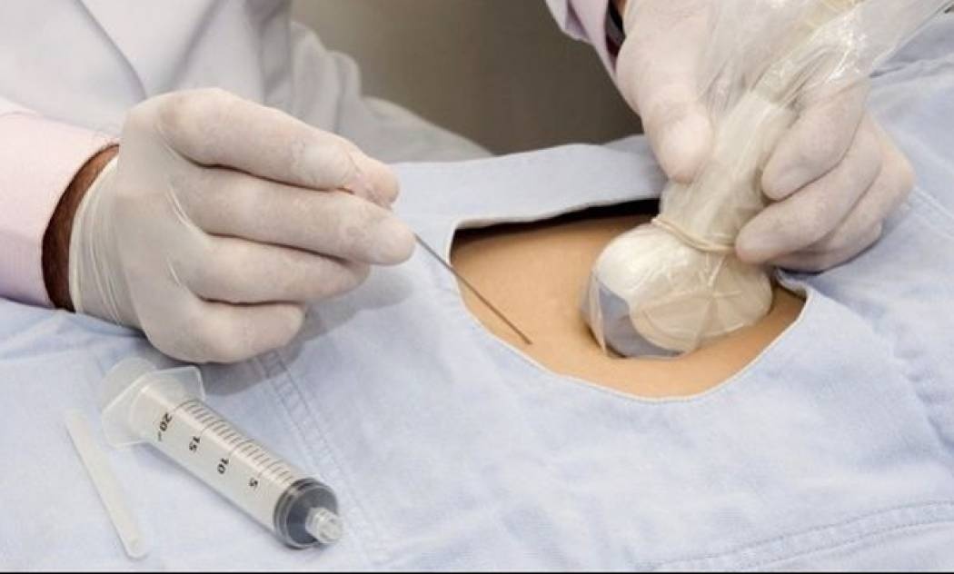 Αμνιοπαρακέντηση: Γιατί δεν πρέπει να φοβάστε