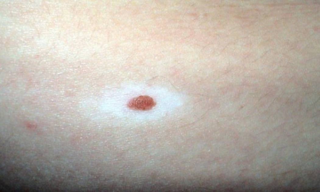 Ελιές με λευκό στεφάνι: Πόσο επικίνδυνες είναι, τι τις προκαλεί