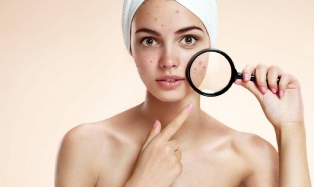 Σπυράκια: Πώς θα τα αντιμετωπίσετε μόνο με αλόη!