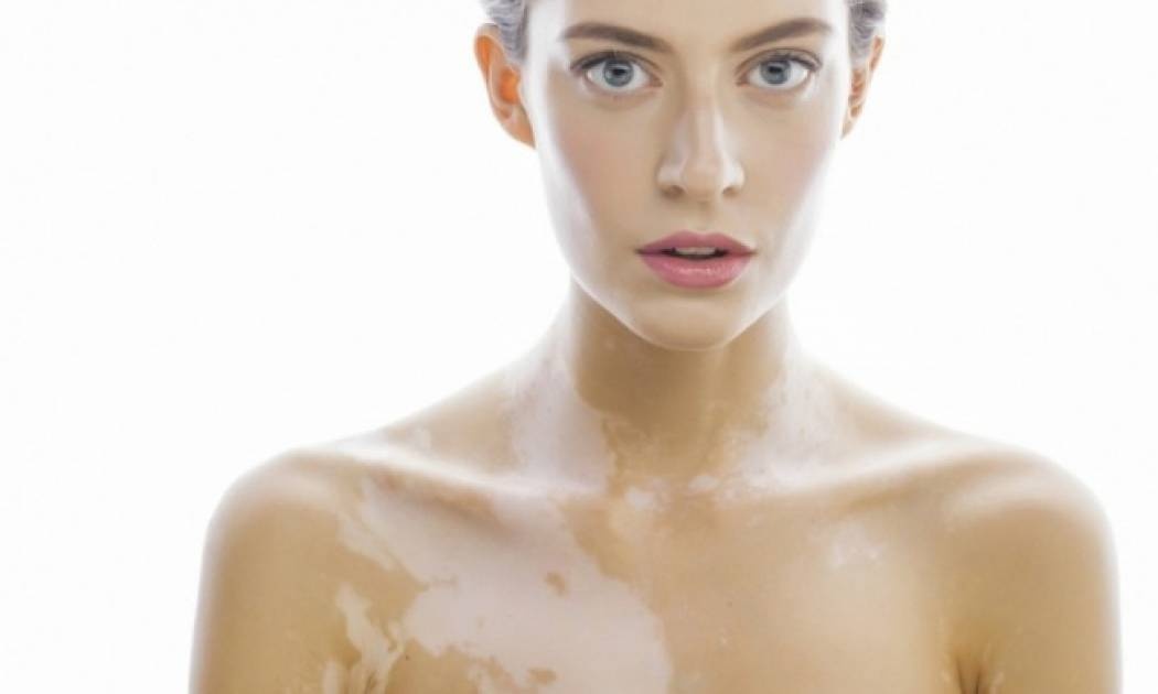 Λεύκη: Γιατί δημιουργούνται λευκές κηλίδες στο δέρμα