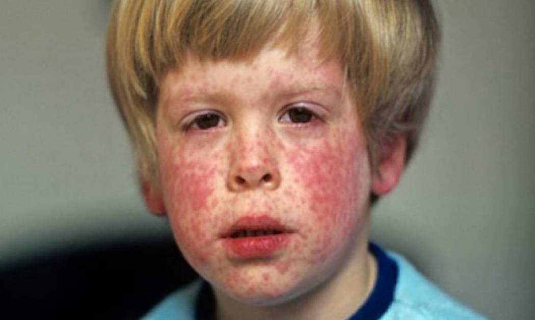 Ερυθρά: Πώς μεταδίδεται και γιατί είναι πολύ επικίνδυνη για τις έγκυες