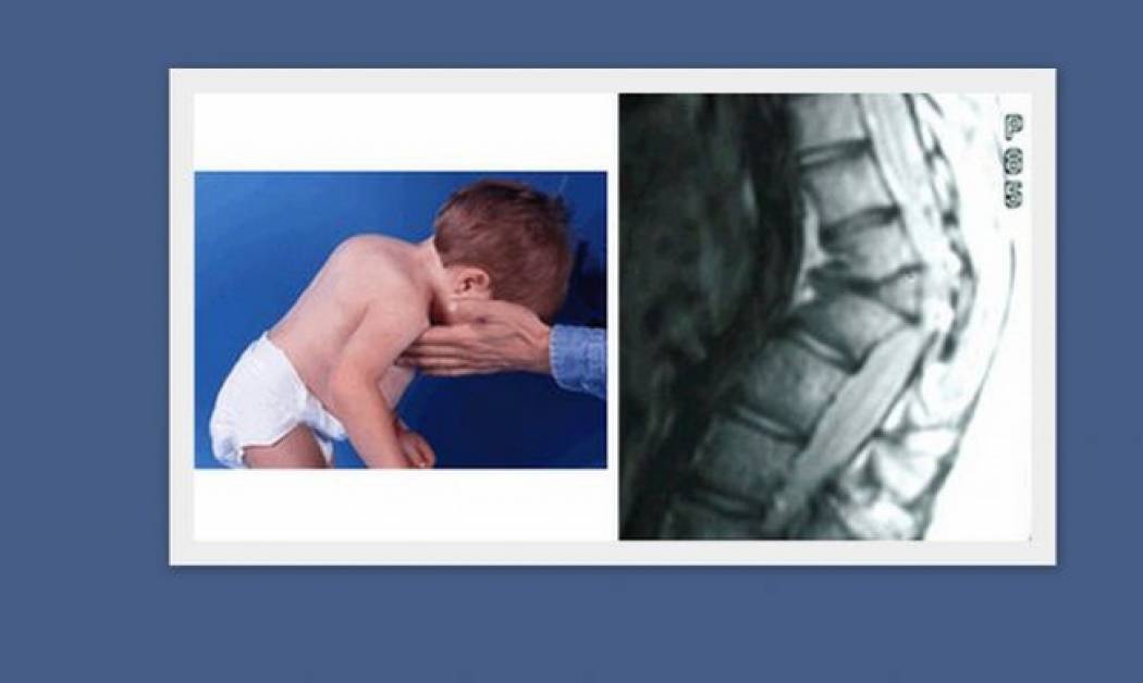 Νόσος Scheuermann: Τι είναι και πότε εμφανίζεται στα παιδιά