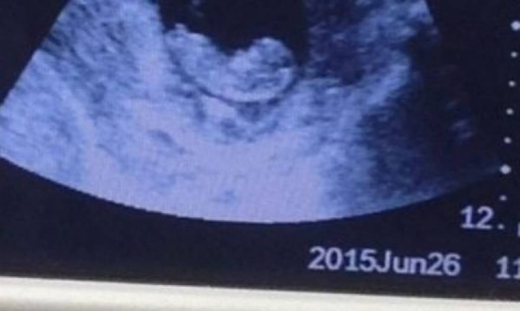 Ανατριχιαστική εικόνα: «Δαίμονας» σε υπέρηχο εμβρύου