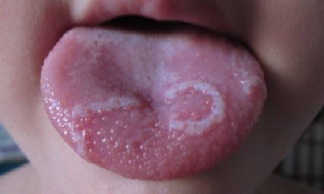 Κάψιμο στη γλώσσα; Δείτε πώς θα ανακουφιστείτε