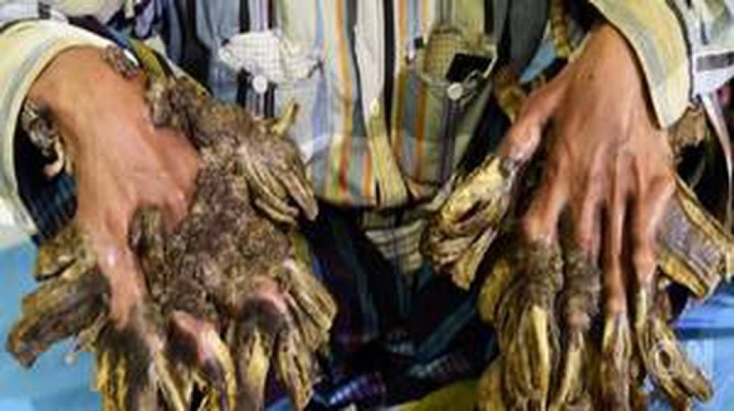 Βίντεο: Ο «άνθρωπος – δέντρο» και η συγκλονιστική ιστορία του