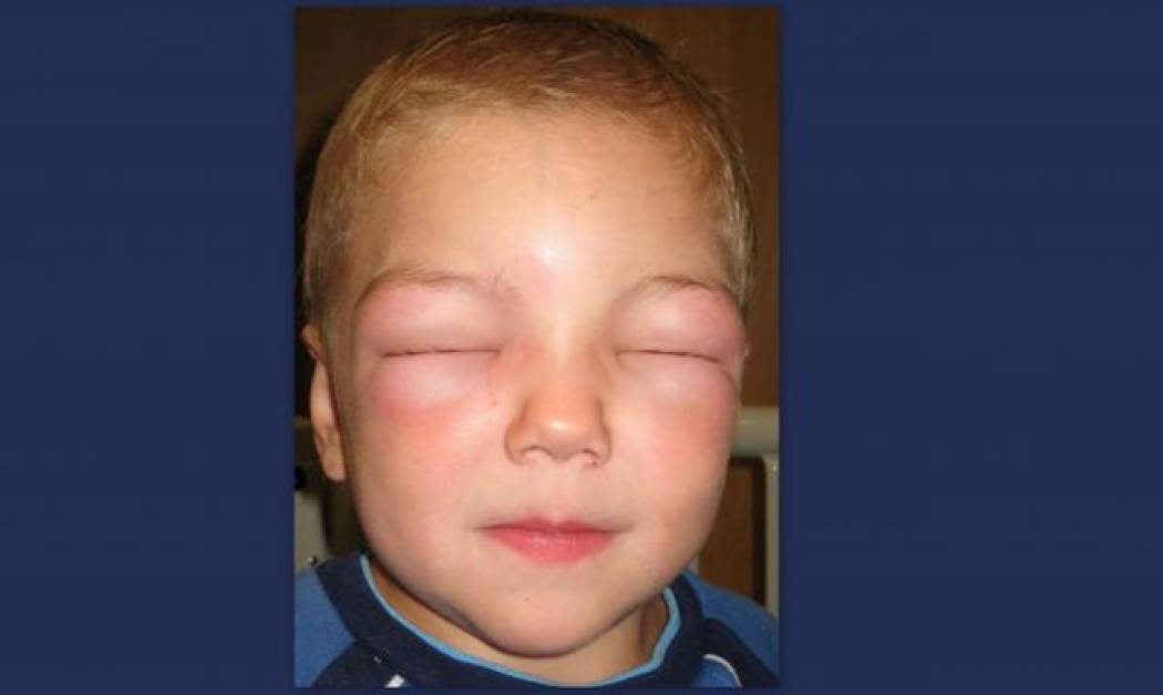 Τι είναι η αναφυλαξία και ποια τα αίτια εμφάνισής της στα παιδιά