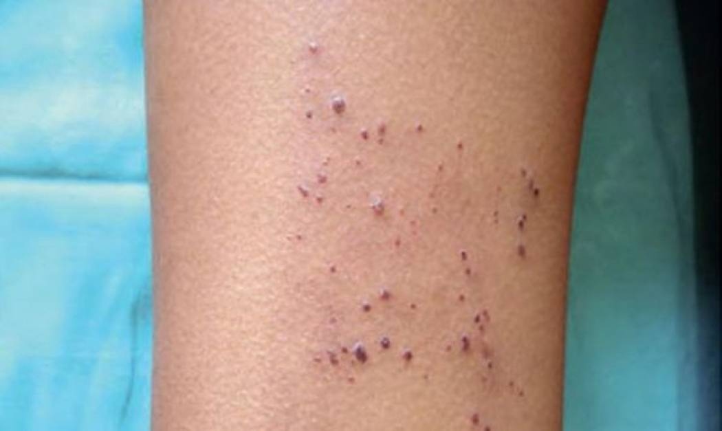 Νόσος Fabry: Τι είναι και τι μπορεί να προκαλέσει στα παιδιά