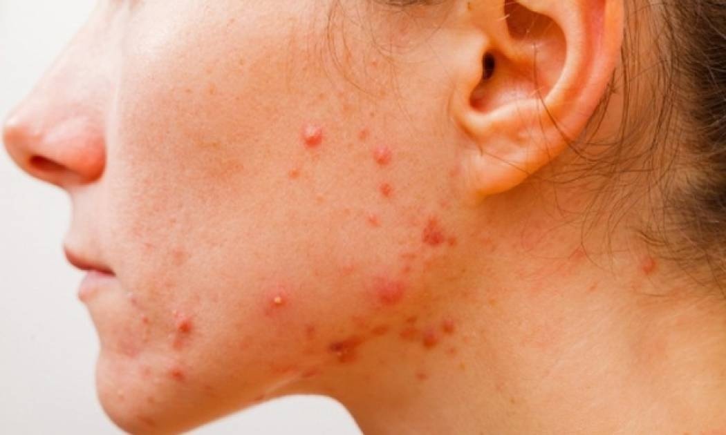 Ακμή: Οι καθημερινές συνήθειες που την πυροδοτούν