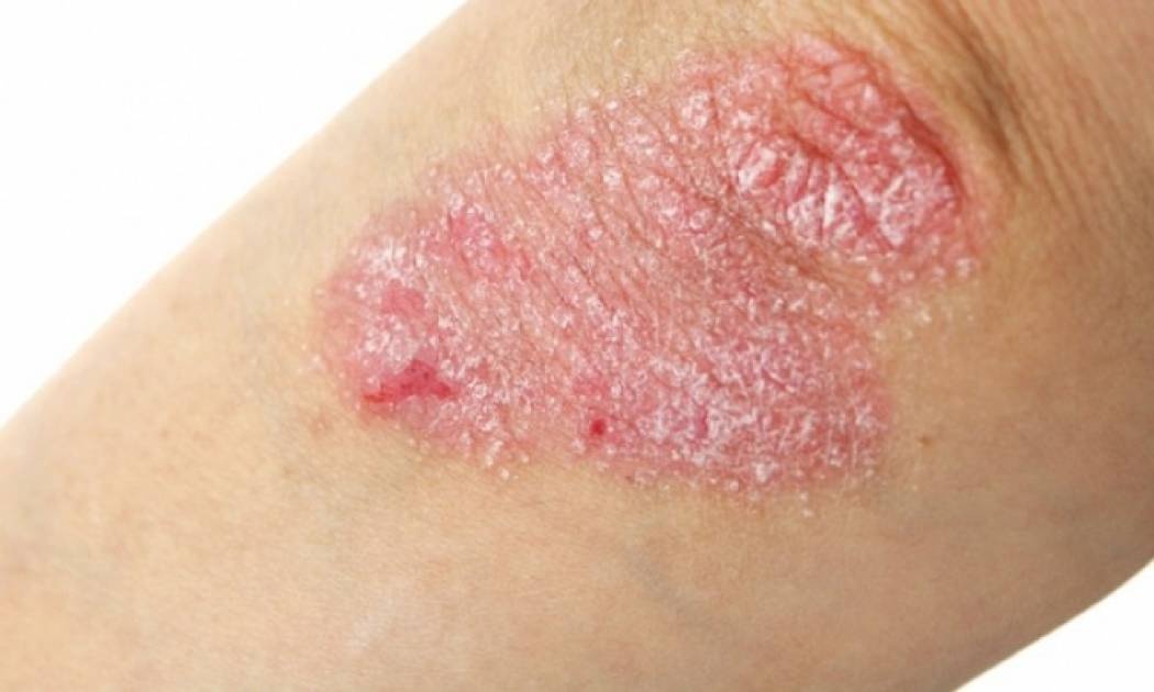 Γυναίκες με ψωρίαση: Από ποιες άλλες παθήσεις κινδυνεύουν