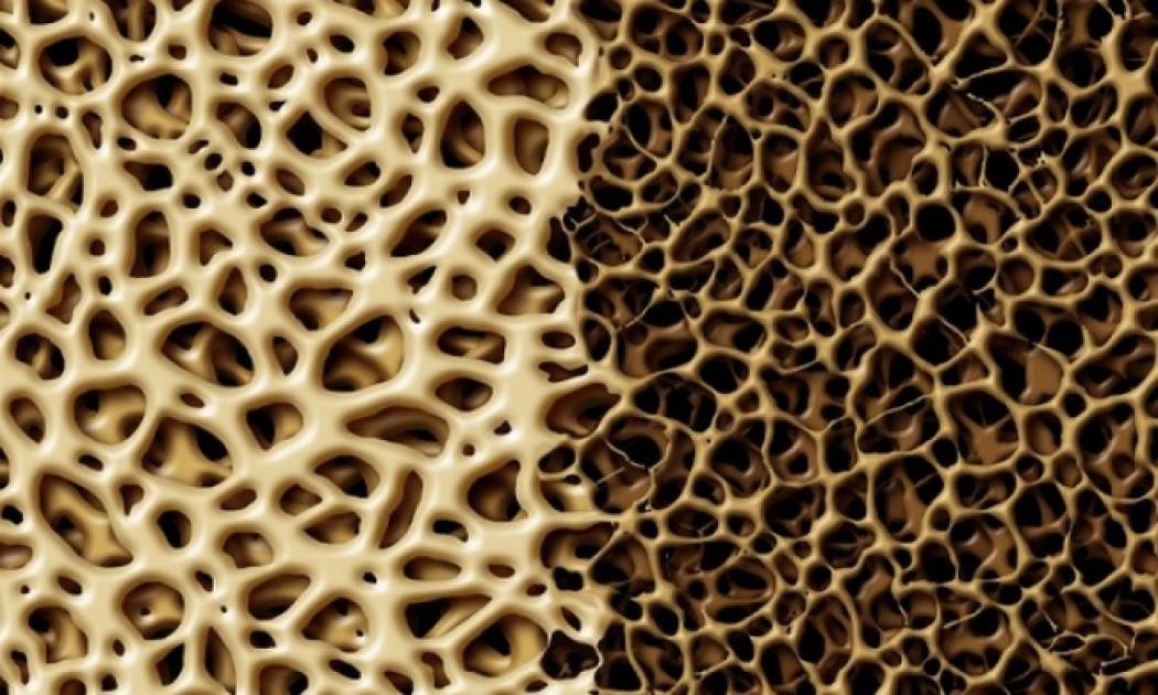 Μέτρηση οστικής πυκνότητας: Πόσο συχνά πρέπει να γίνεται;