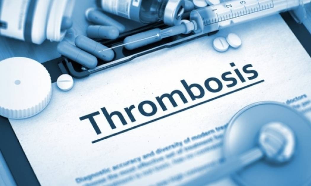 Θρομβοεμβολή στις γυναίκες: Ο παράγοντας που αυξάνει τον κίνδυνο