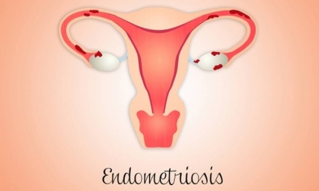 Ενδομητρίωση: Πόσο αυξάνει τον κίνδυνο καρκίνου