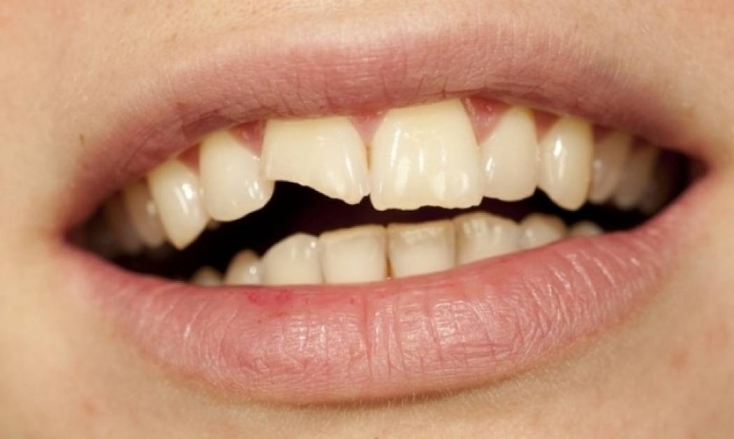 Τραυματισμοί των δοντιών: Ποιες είναι οι πρώτες βοήθειες;