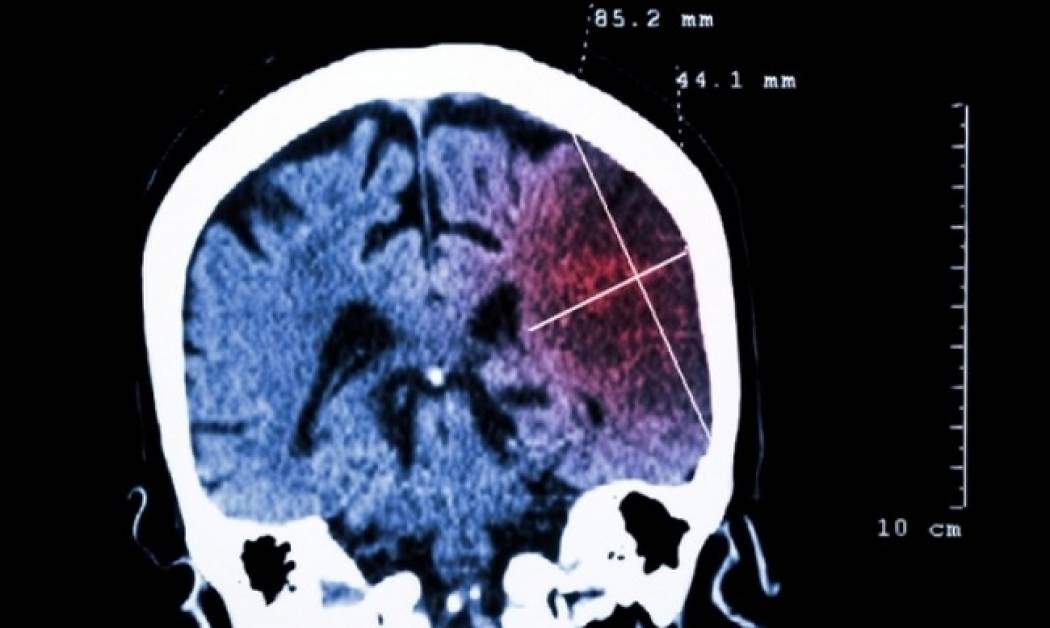 Lancet: Ο παγκόσμιος «χάρτης κινδύνου» για τα εγκεφαλικά