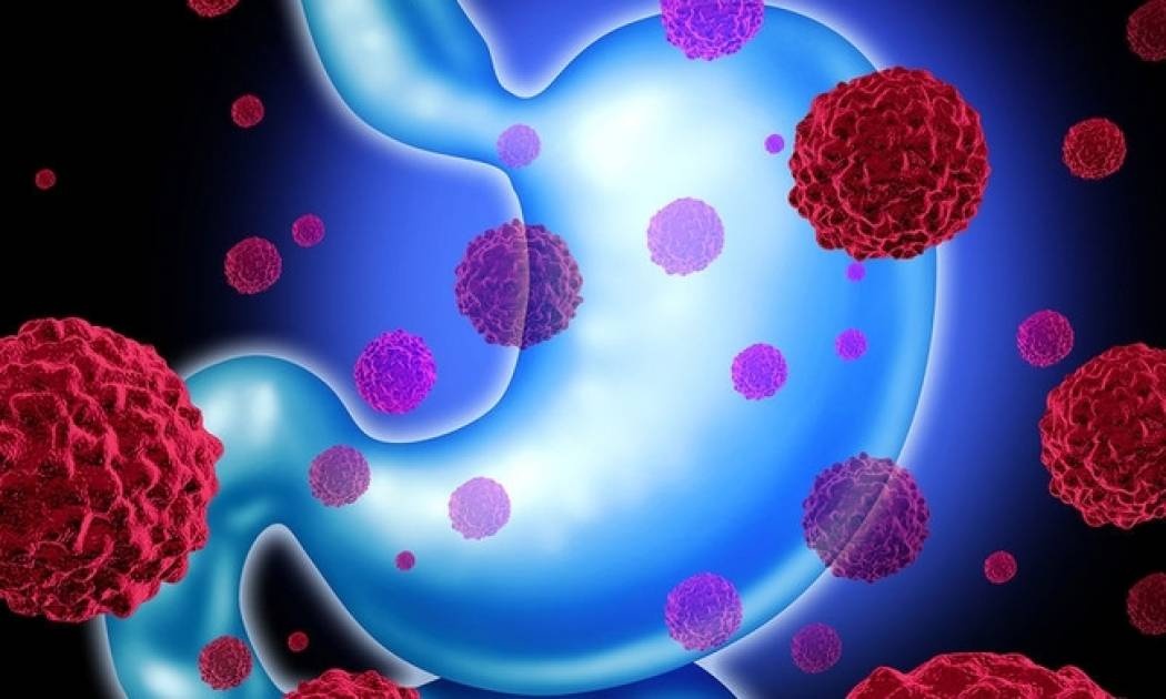 Καρκίνος του στομάχου: Μπορούμε να τον αποφύγουμε