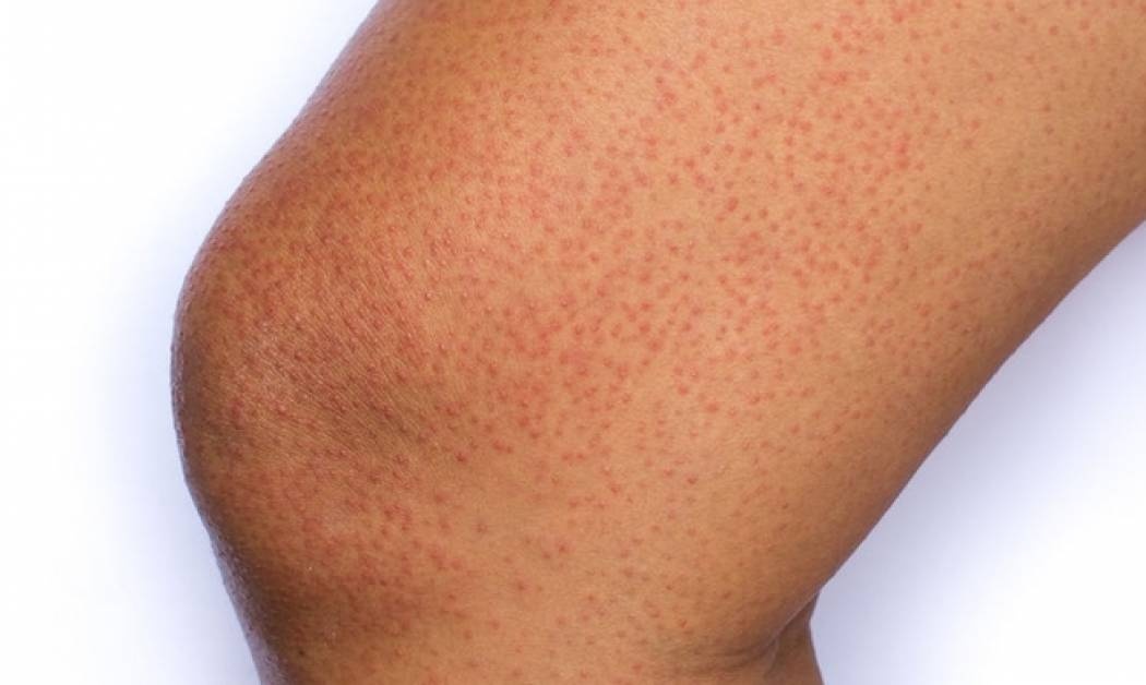 Θυλακική υπερκεράτωση: Πώς θα αντιμετωπίσετε τις επίμονες κοκκινίλες στο δέρμα