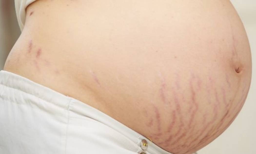 Ραγάδες στην εγκυμοσύνη; Μάθετε τα πάντα