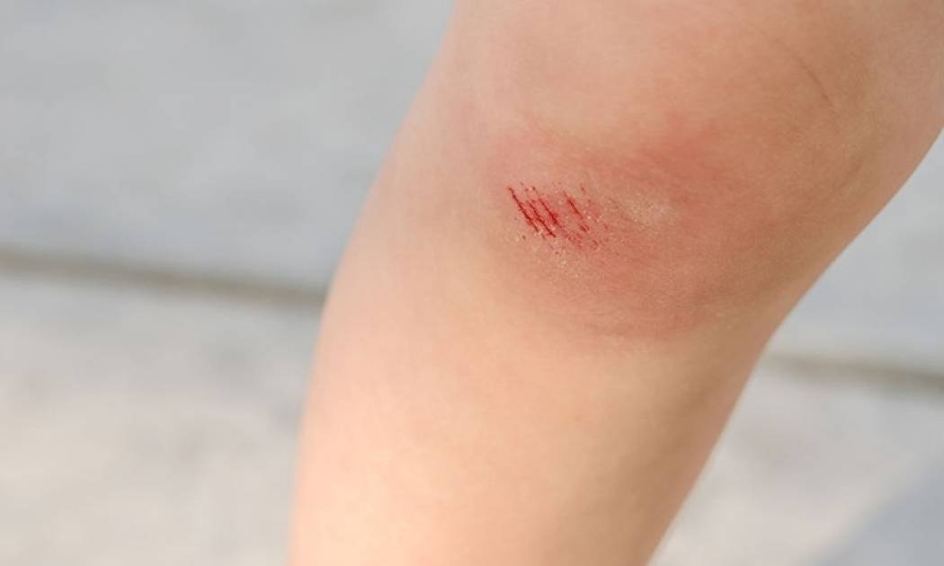 Πώς θα καταλάβετε ότι μια πληγή έχει μολυνθεί