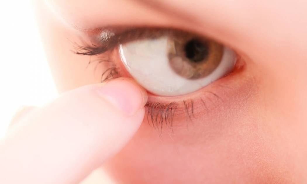 Κριθαράκι στο μάτι: Η λύση βρίσκεται στην κουζίνα σας!