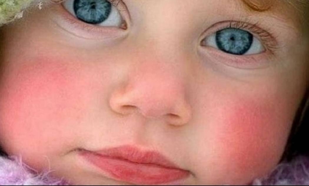 Ποιοι είναι οι λόγοι που ένα μωρό έχει κόκκινα μάγουλα;