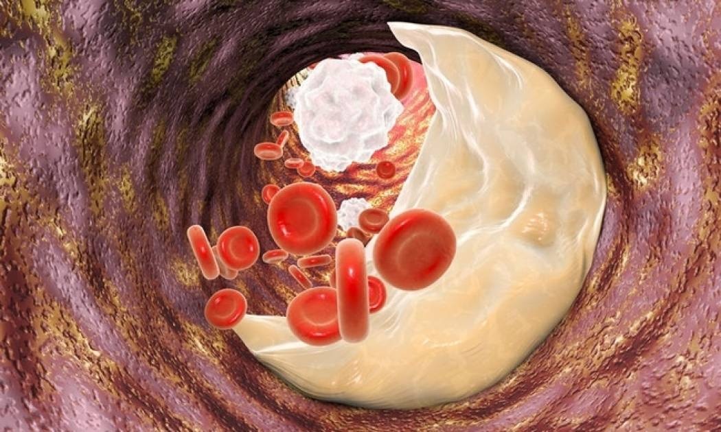 Στεφανιαία νόσος: Ο διατροφικός δεκάλογος της πρόληψης