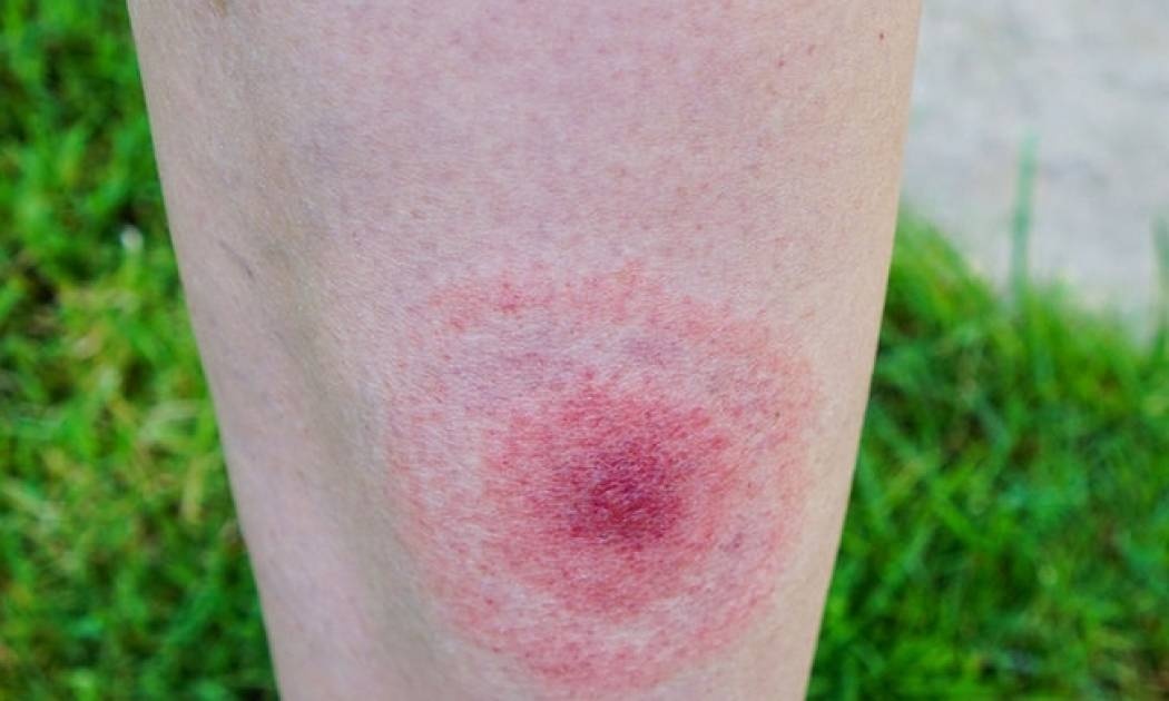 Τι πρέπει να κάνετε αν σας τσιμπήσει τσιμπούρι