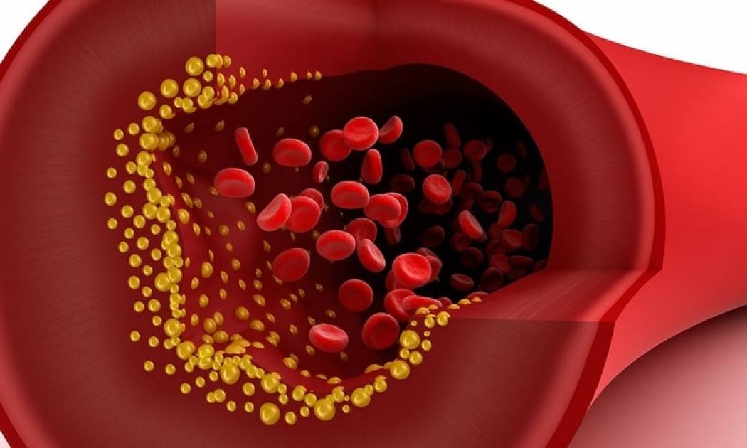 Αθηροσκλήρωση: Με ποια διατροφή θα προστατεύσετε τα αγγεία σας