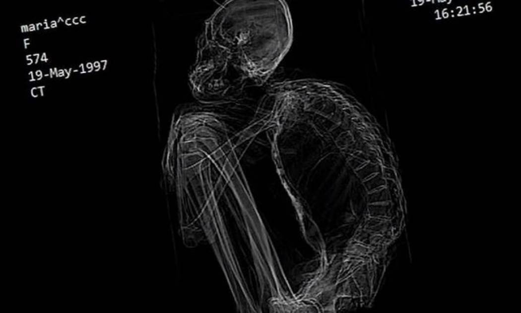 Περού: Βρέθηκε «εξωγήινη» μούμια με τρία δάκτυλα (vid)