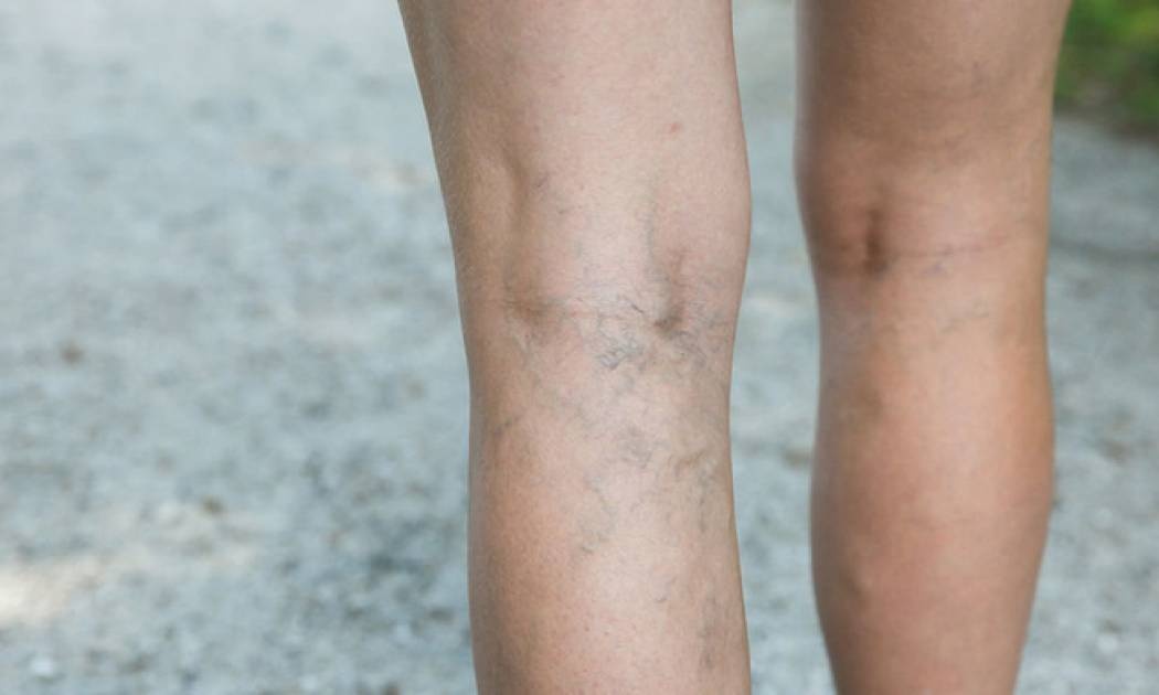 Πόδια που «καίνε»: Πώς θα ανακουφιστείτε το καλοκαίρι