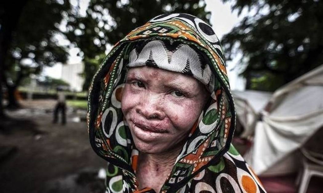 Κυνήγι «μαγισσών» στην Τανζανία: Τουλάχιστον 80 γυναίκες στραγγαλίστηκαν, μαχαιρώθηκαν ή κάηκαν