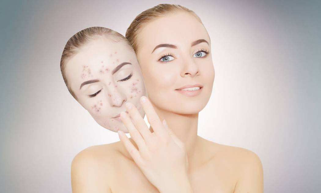 Ακμή ενηλίκων: Τέσσερις κοινές αιτίες και πώς θα την αντιμετωπίσετε