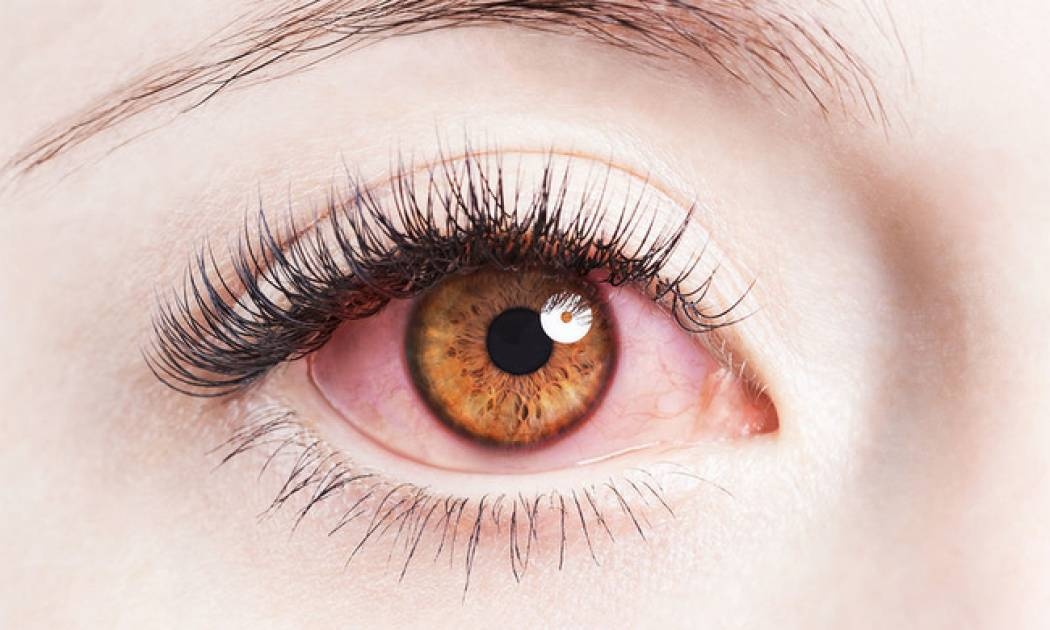 Κοκκίνισμα ματιών: Επτά πιθανές αιτίες & τι μπορείτε να κάνετε