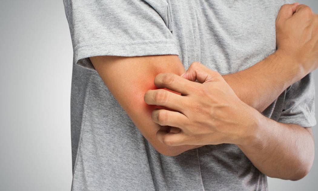 Ψωρίαση vs. έκζεμα: Όλες οι διαφορές μέσα από φωτογραφίες