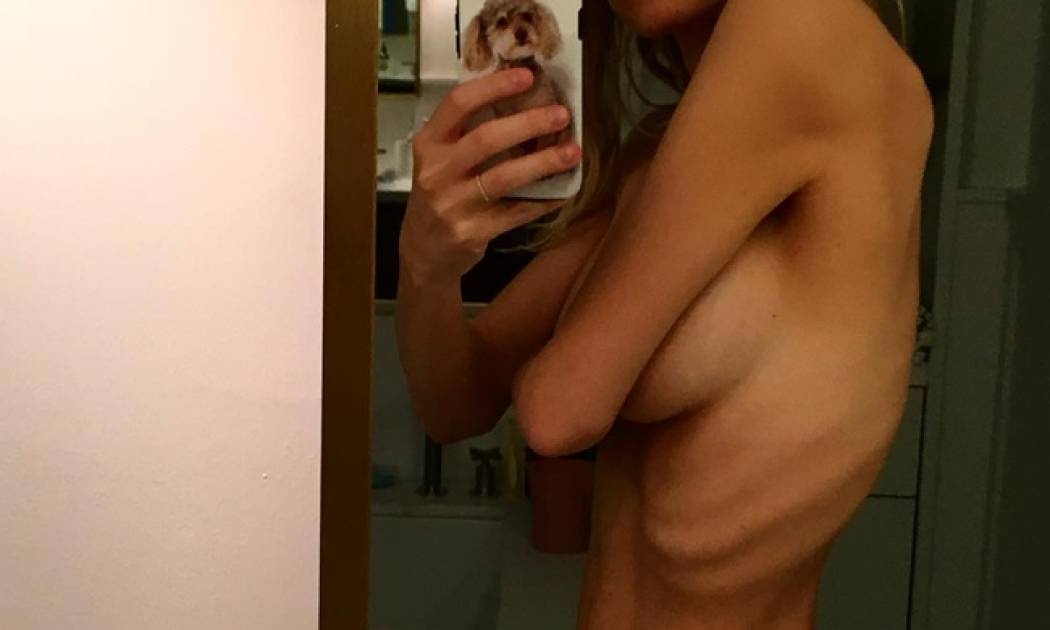 Η γνωστή ηθοποιός σοκάρει με την εικόνα της: «Δεν είναι ανορεξία... πρόκειται για θυρεοειδή»