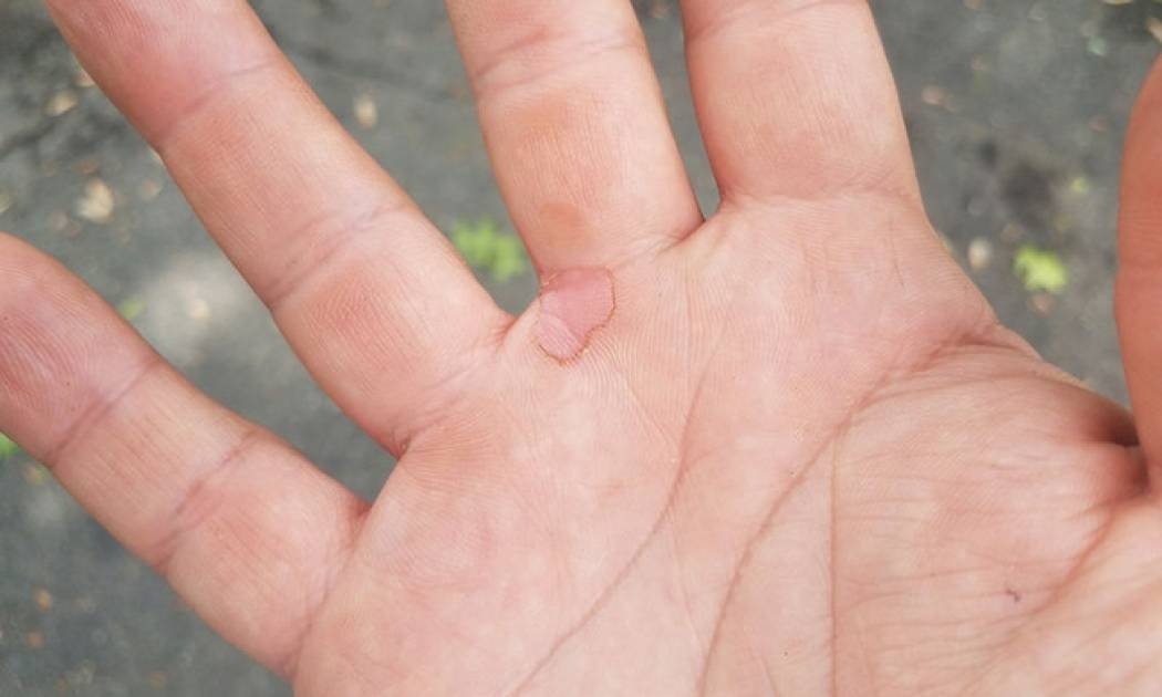 Φουσκάλες στο δέρμα: Αντιμετώπιση σε 3 βήματα