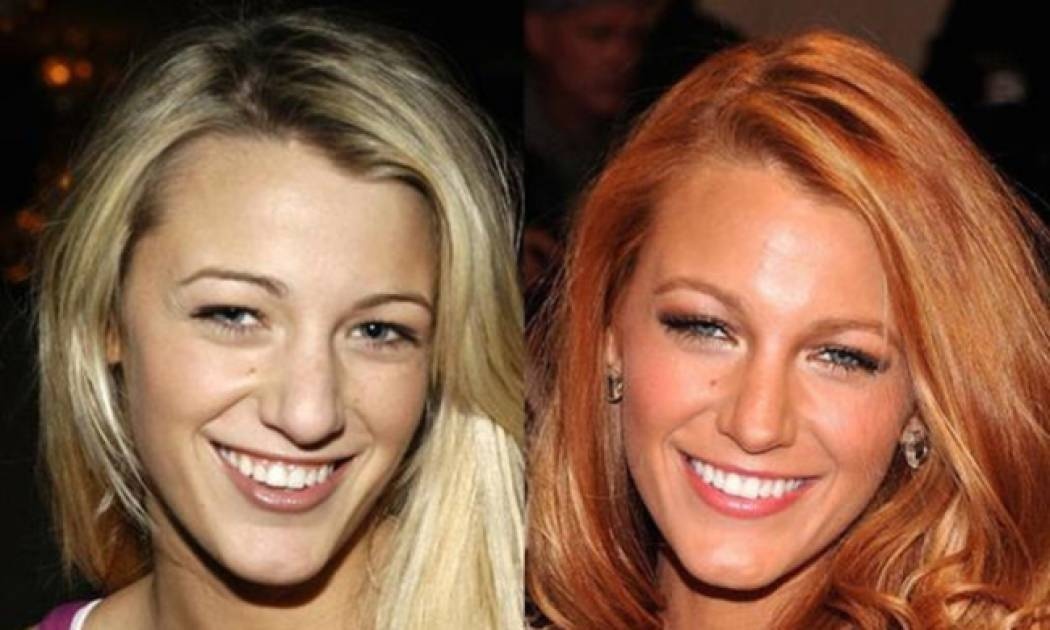 14 φωτογραφίες διασήμων πριν και μετά την ρινοπλαστική